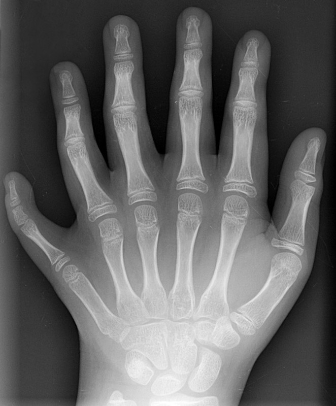 Polydactyly_01_Lhand_AP.jpg